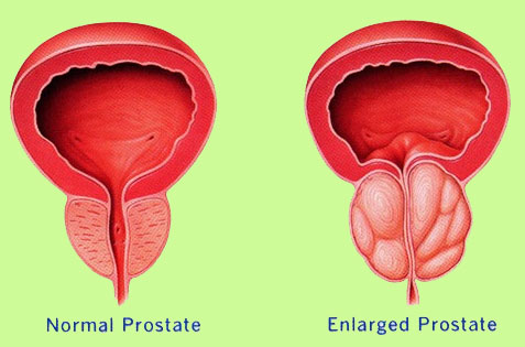 Нормална и увеличена простата