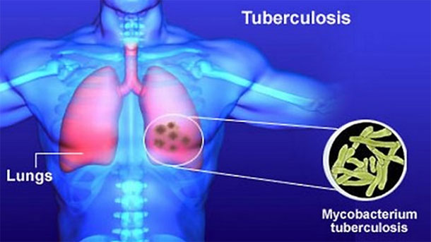 Болните от туберкулоза в България намаляват през последните 9 години,
