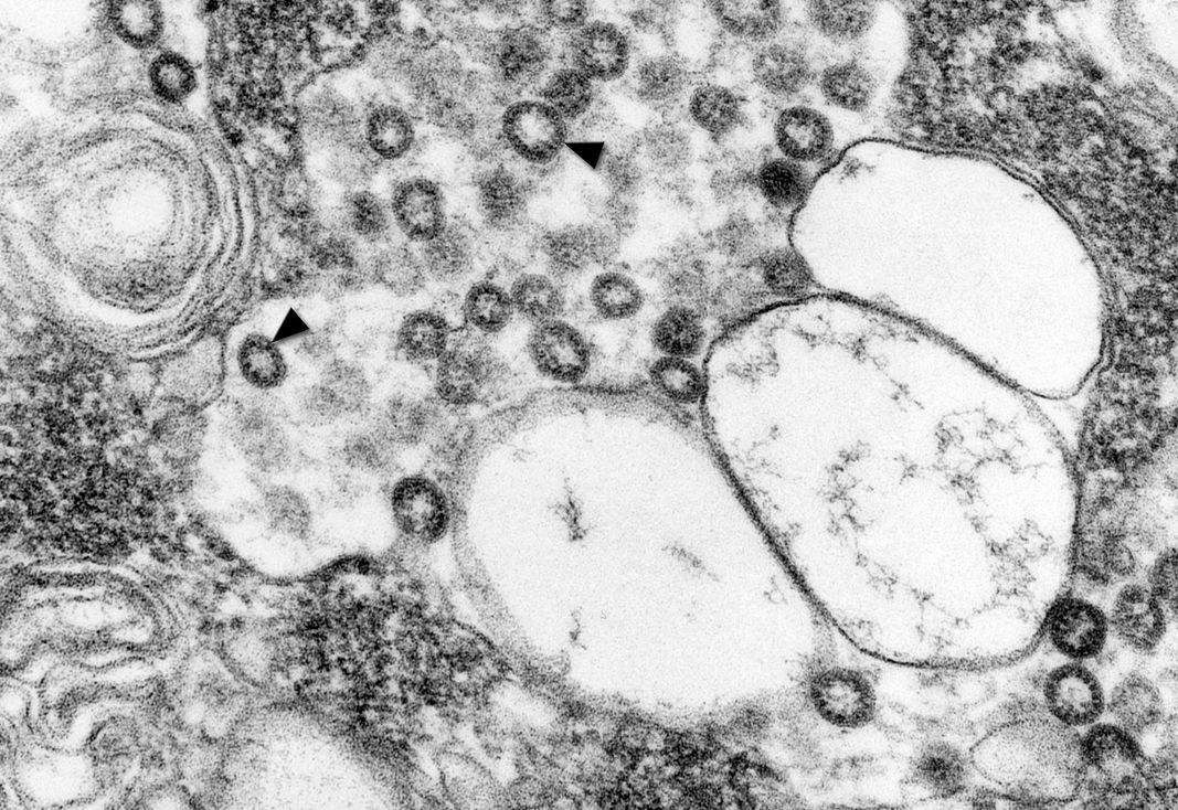 Снимка на тъкан от изолирана култура показва няколко вириона, причиняващи Тежък остър респираторен синдром (SARS). Някои от тях са посочени със стрелки Снимка: CDC/ С. Голдсмит, Т. Ксяжек